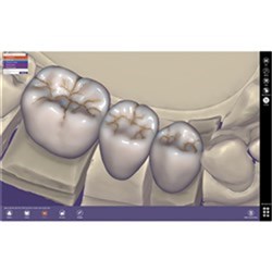 Exocad DentalCAD Tru Smile Module Perpetual