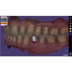 Exocad DentalCAD Implant Module Flex